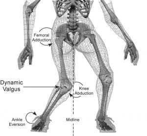 valgus collapse